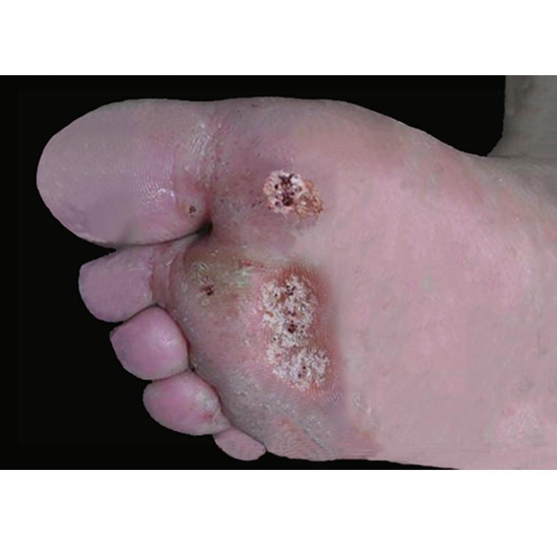 夏天，要当心几个行为可招致“疣”、刺瘊传染增多