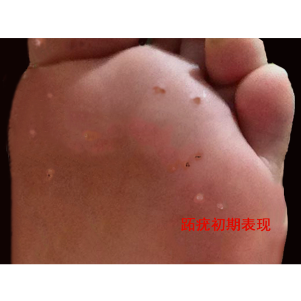 护肤，你留意脚底皮肤了吗？有的不疼不痒也需注意