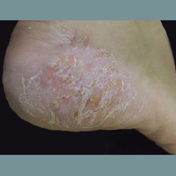 盛夏酷暑，脚干、起皮，脚跟还有厚厚的硬皮