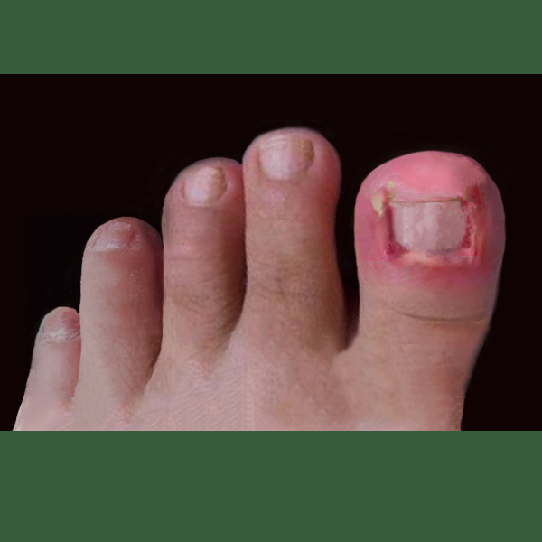 指（趾）端红肿热痛、渗出溃脓，甲沟炎不是小事