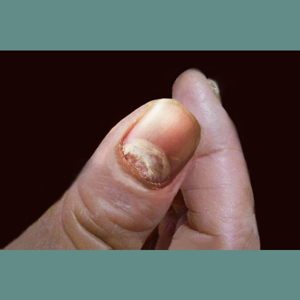 灰指甲是怎么形成的？