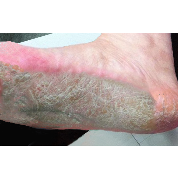 手、足出现角化的增厚、干燥、脱屑、红色斑片，是什么