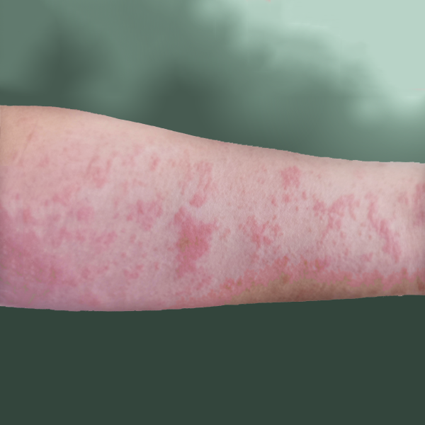 “秋燥”起，防范皮肤问题，三类“发物”要警惕