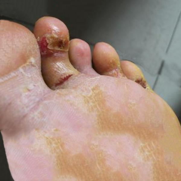 脚气，为什么反反复复？怎么能好彻底