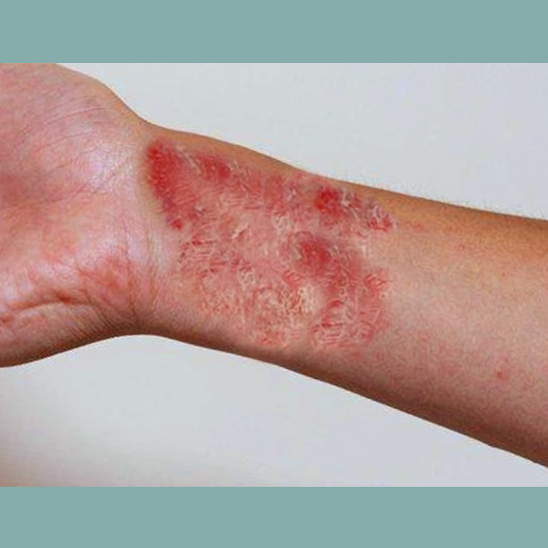 干性湿疹是怎么回事