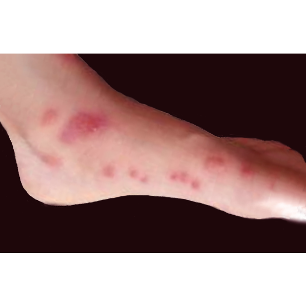 脚上长水疱、瘙痒、渗液糜烂，是脚气还是湿疹