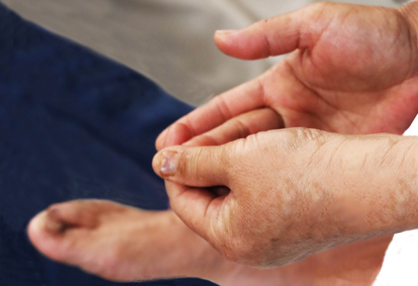 灰指甲，指甲营养不良，怎么辨别？