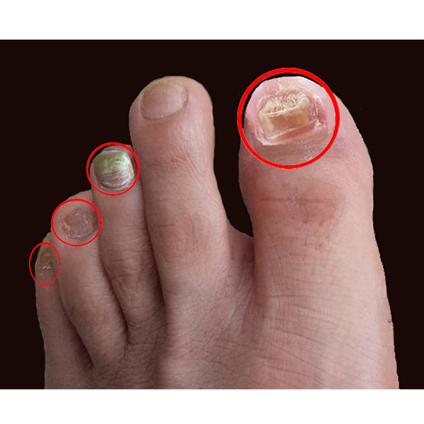 冬季去灰指甲更有利！正确护理加上两大注意，高效长新甲