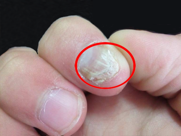灰指甲是怎么造成的？有哪些关键的问题
