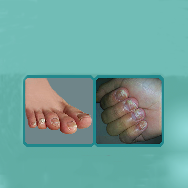 灰指甲形成的“路径”是怎样的？