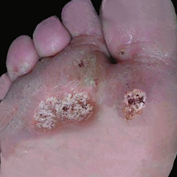 刺瘊（疣）因生长部位不同表现各异，并不只是菜花状凸起