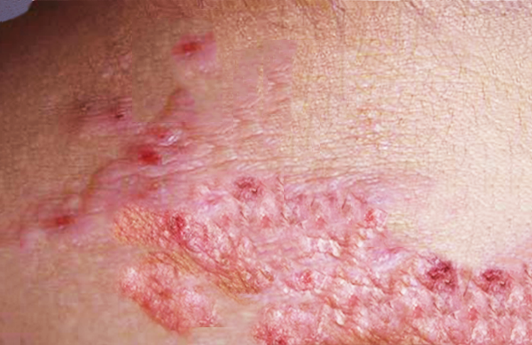 皮肤上没出现皮疹，却阵发性剧烈瘙痒，越抓越痒，引发扁平丘疹，怎么回事？