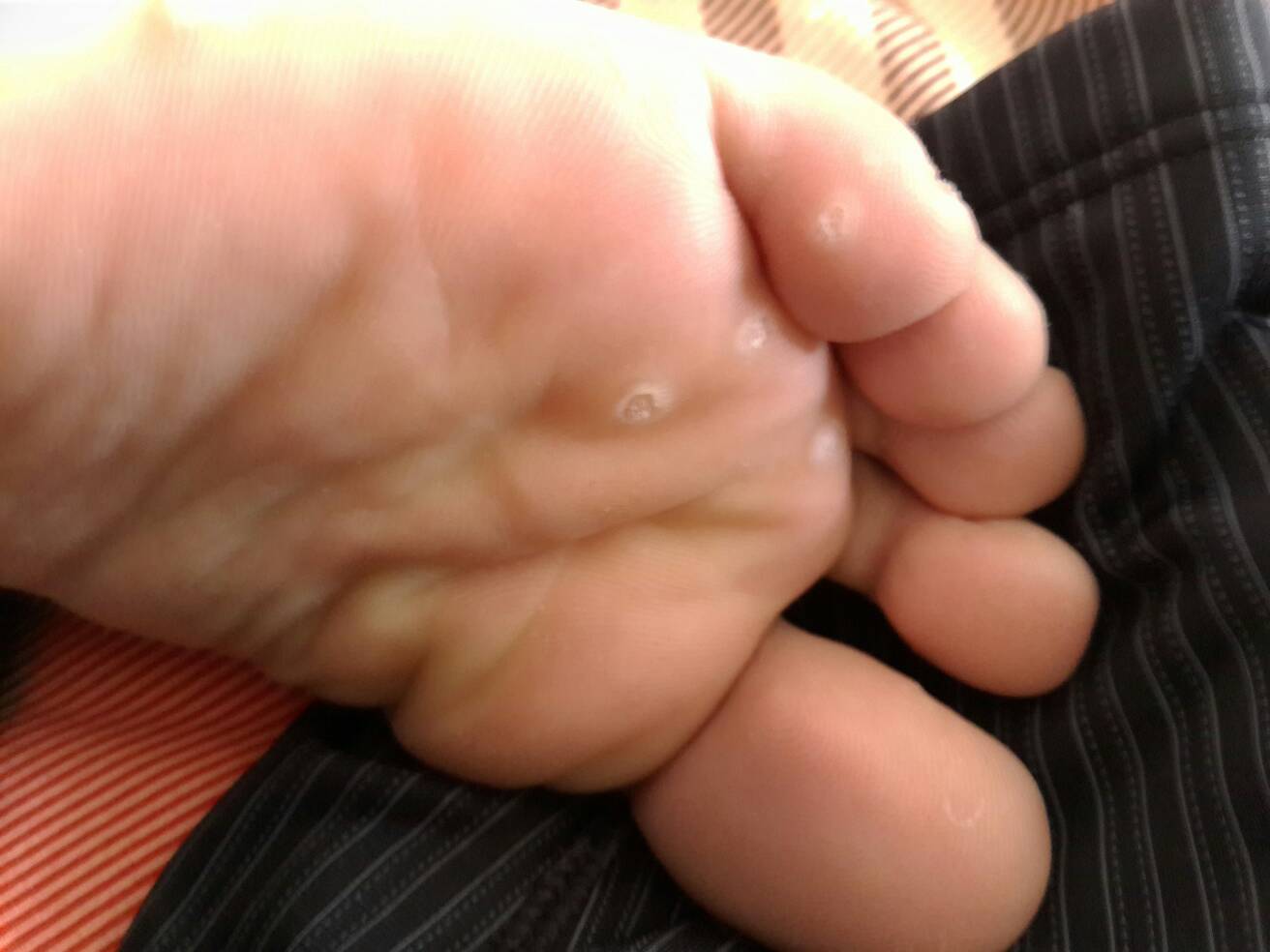 刺猴和鸡眼的区别是什么