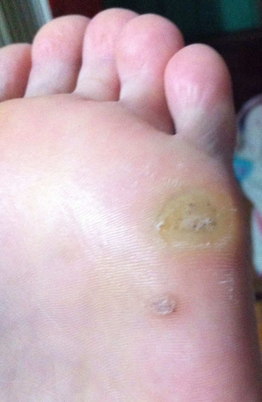 刺猴和鸡眼的区别是什么