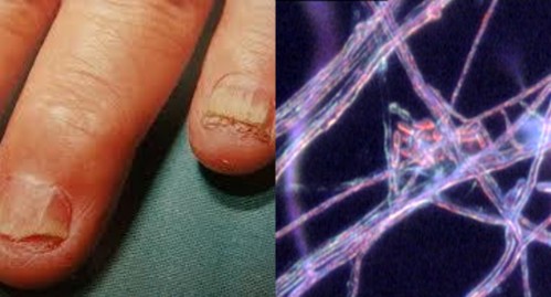 不可不知"灰指甲"真菌自身传染可导致的颅内,肠内等疾病