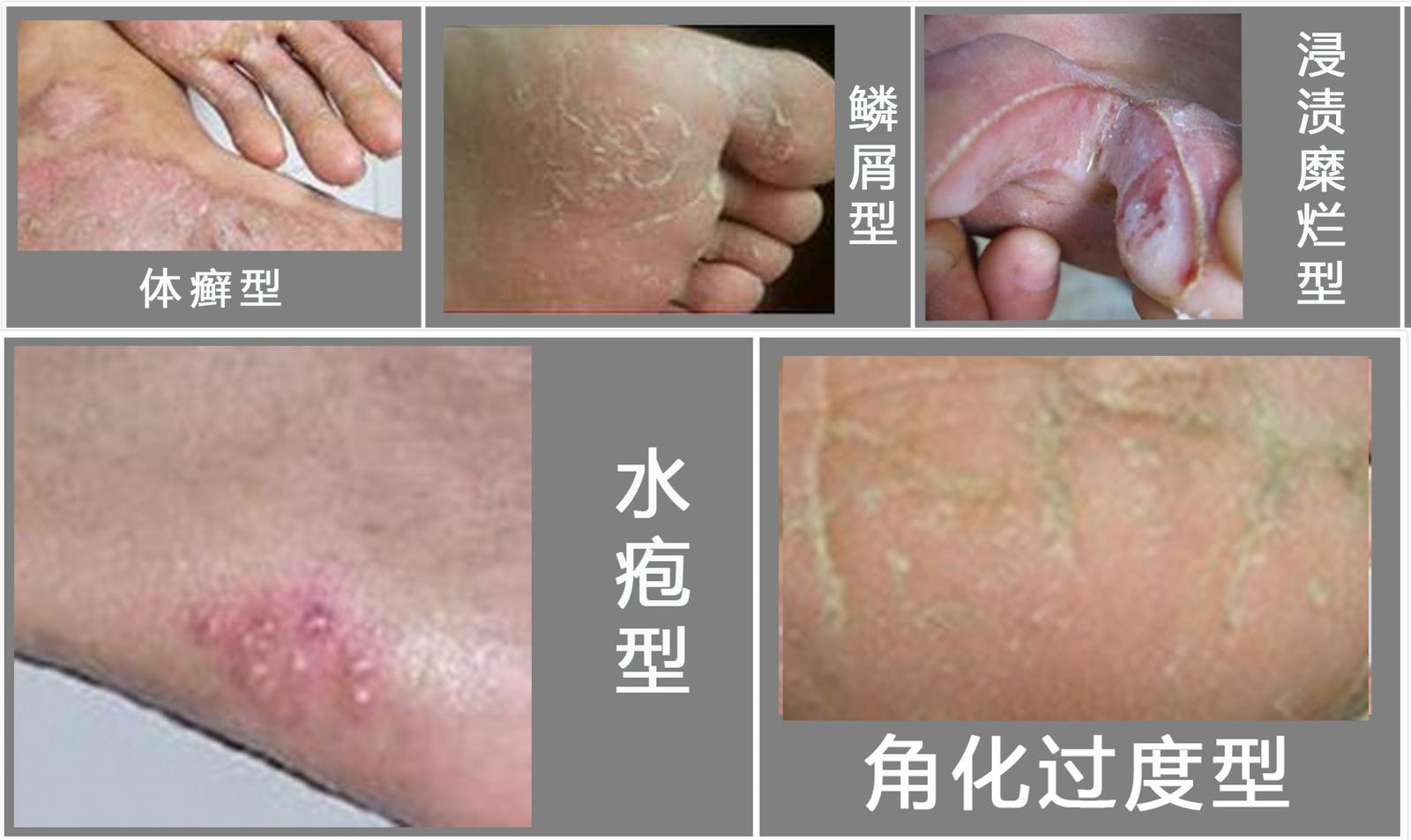 根据手足癣患者感染的真菌不同,临床上将脚气分为水疱型,鳞屑型,浸渍